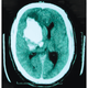 A tomography scan of the brain hemorrhage suffered by a tourist stung by several irukandjis at a beach in the Whitsundays.